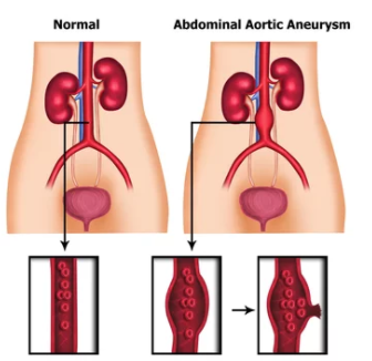 Aortic Aneurysm and Life insurance