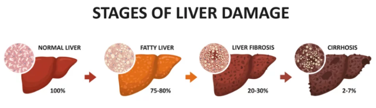 Burial Insurance With Cirrhosis Of The Liver and Liver Disease ...